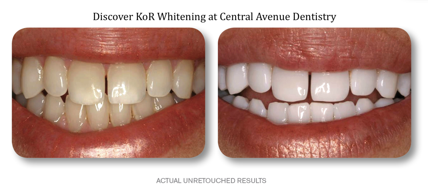 Unlock Your Brightest Smile with KoR Whitening at Central Avenue Dentistry!